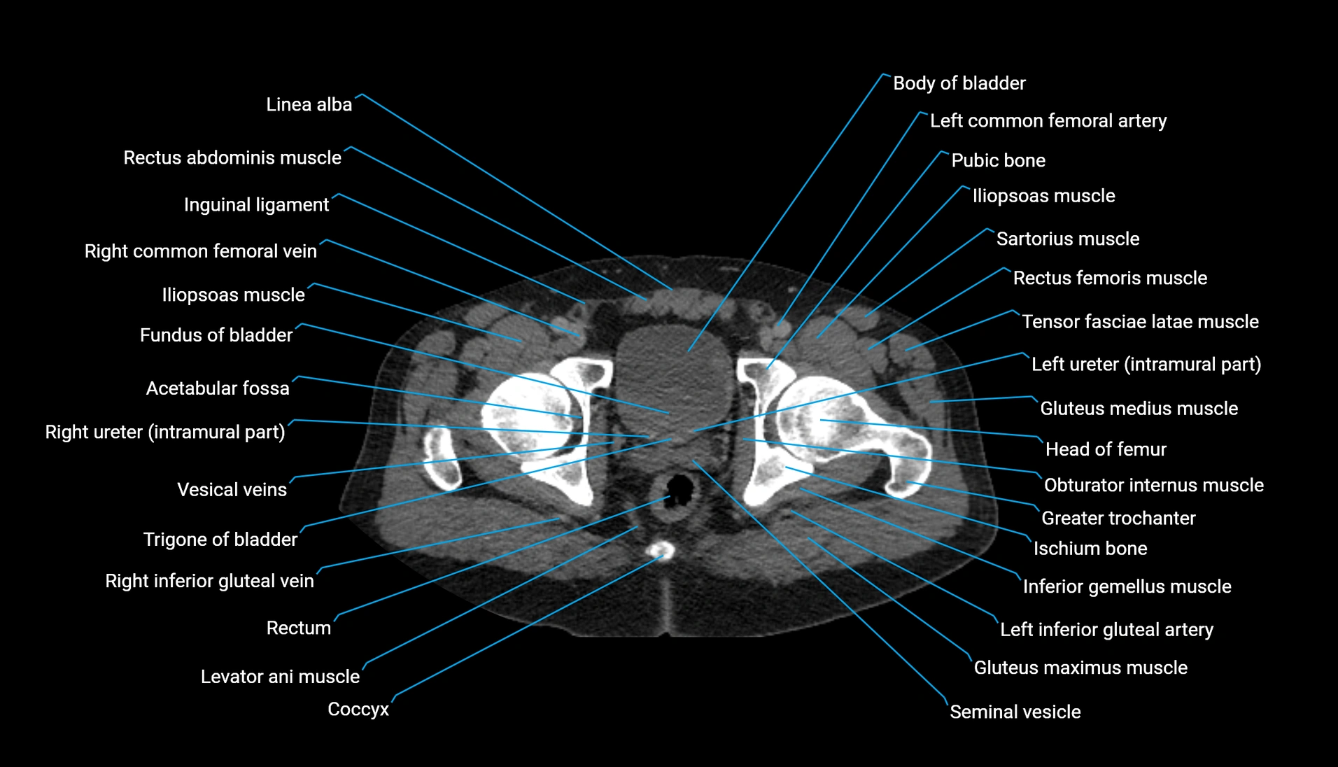 CT urogram axial cross sectional anatomy  labelled radiology image-00237.webp